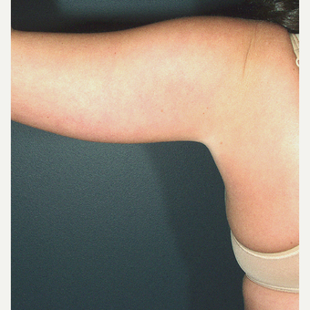 25-34 year old woman treated with Liposuction - arms improved before 3664487