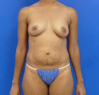 34y.o. female - breast augmentation & abdominoplasty; 397cc / 457 cc silicone implants before 1032028
