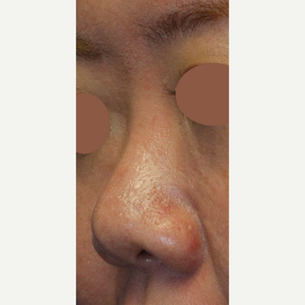 Asian Rhinoplasty To Augmentin Bridge, Project Tip an Narrow Nostrils before 3672430
