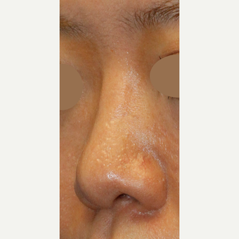 Asian Rhinoplasty To Augmentin Bridge, Project Tip an Narrow Nostrils after 3672430
