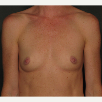 25-34 year old woman treated with Breast Implants before 3026421