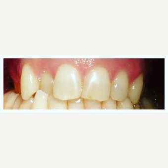 Quick Dental Braces before 3128353