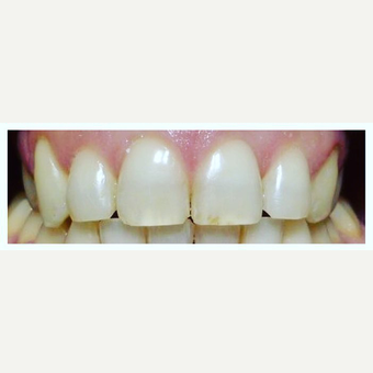 Quick Dental Braces after 3128353