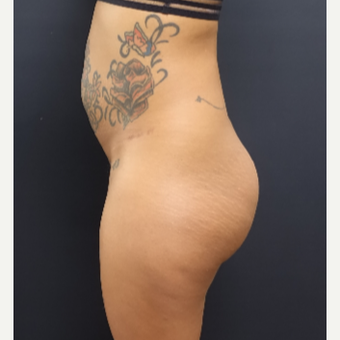25-34 year old woman treated with 712cc Round Silicone Butt Implants before 3129126