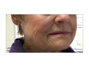 74 year old woman treated with Mohs Surgery after 1341054