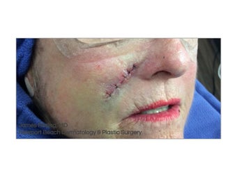 74 year old woman treated with Mohs Surgery before 1341054