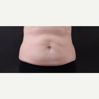 55 year old woman treated with CoolSculpting after 3220703