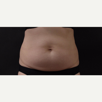 55 year old woman treated with CoolSculpting before 3220703