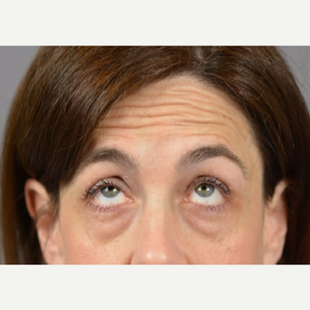 45-54 year old woman treated with Eyelid Surgery before 3411482