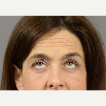 45-54 year old woman treated with Eyelid Surgery after 3411482