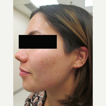 18-24 year old woman treated with Acne Scars Treatment after 2115428