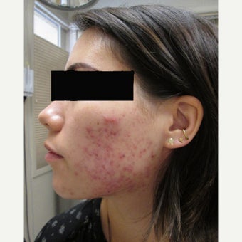 18-24 year old woman treated with Acne Scars Treatment before 2115428