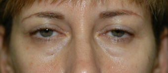 42 year old woman has 4 lid bleph with no "visible incision approach" before 1604918