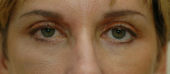 42 year old woman has 4 lid bleph with no "visible incision approach" after 1604918