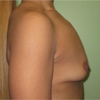 25-34 year old woman treated with Breast Implants before 3423862