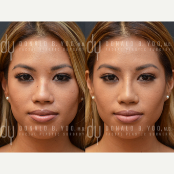 Non Surgical Nose Job before 3622610
