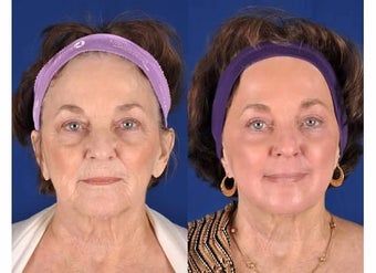 Phenol Peel before 1355847