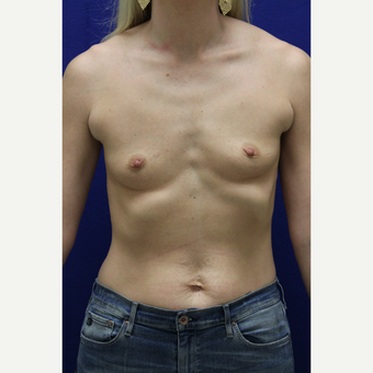 25-34 year old woman treated with Breast Augmentation before 3383372