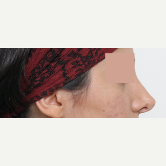 25-34 year old woman treated with Revision Rhinoplasty before 3777231