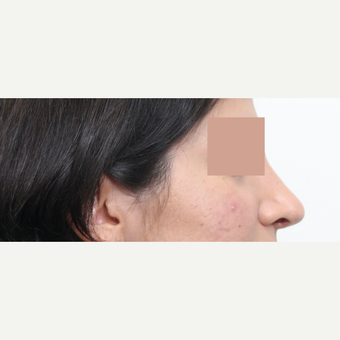 25-34 year old woman treated with Revision Rhinoplasty after 3777231