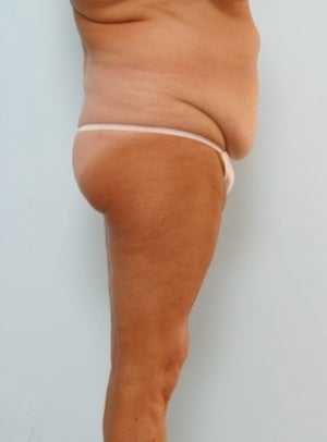 Body Lift before 1037872