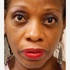 Woman treated with Botox before 1686601
