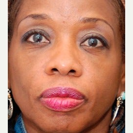 Woman treated with Botox after 1686601