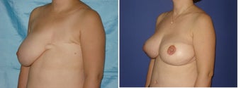 45 year old female treated for mastectomy defect after breast cancer before 1458763