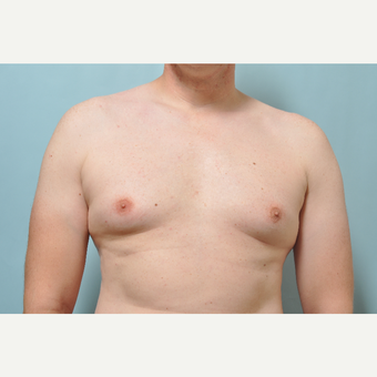 35-44 year old man treated with CoolSculpting before 3226416