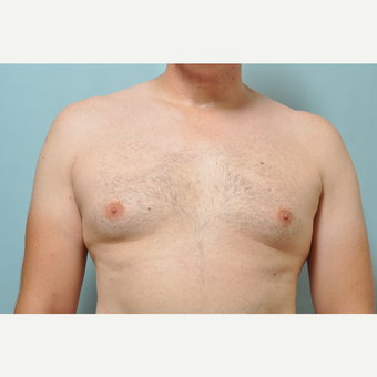 35-44 year old man treated with CoolSculpting after 3226416