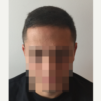 26 years old man treated with FUE Hair Transplant after 3068887