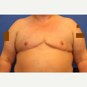 43 year old transgender man treated with FTM Chest Masculinization Surgery after 2109411