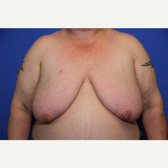 43 year old transgender man treated with FTM Chest Masculinization Surgery before 2109411
