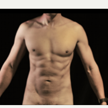 35-44 year old man treated with Vaser Liposuction after 3786741