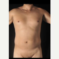35-44 year old man treated with Vaser Liposuction before 3786741