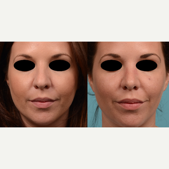 25-34 year old woman treated with Rhinoplasty before 3500682