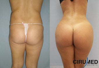 Brazilian butt lift 1150cc before 1057727