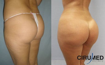 Brazilian butt lift 1150cc after 1057727