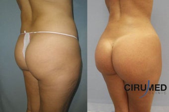 Brazilian butt lift 1150cc 1057727