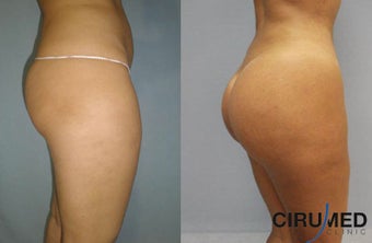 Brazilian butt lift 1150cc 1057727