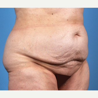 65-74 year old woman treated with Tummy Tuck before 3837521
