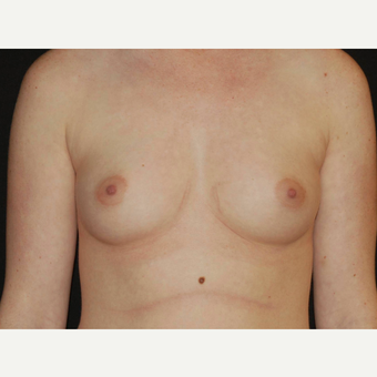 25-34 year old woman treated with Breast Implants before 3650987