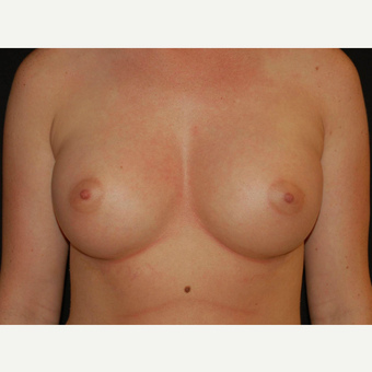 25-34 year old woman treated with Breast Implants after 3650987