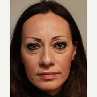 35-44 year old woman treated with Eye Bags Treatment before 2354003