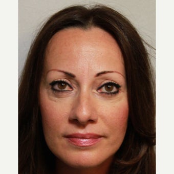 35-44 year old woman treated with Eye Bags Treatment after 2354003
