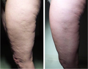 45-54 year old woman treated with Celfina before 3191322