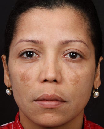 Cosmelan for Melasma before 539871