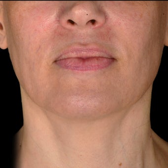 35-44 year old woman treated with Exilis after 3537947
