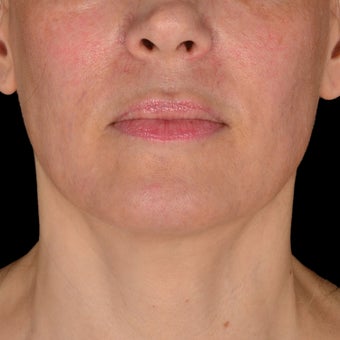 35-44 year old woman treated with Exilis before 3537947