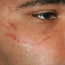 18-24 year old man treated with Scars Treatment before 3758670